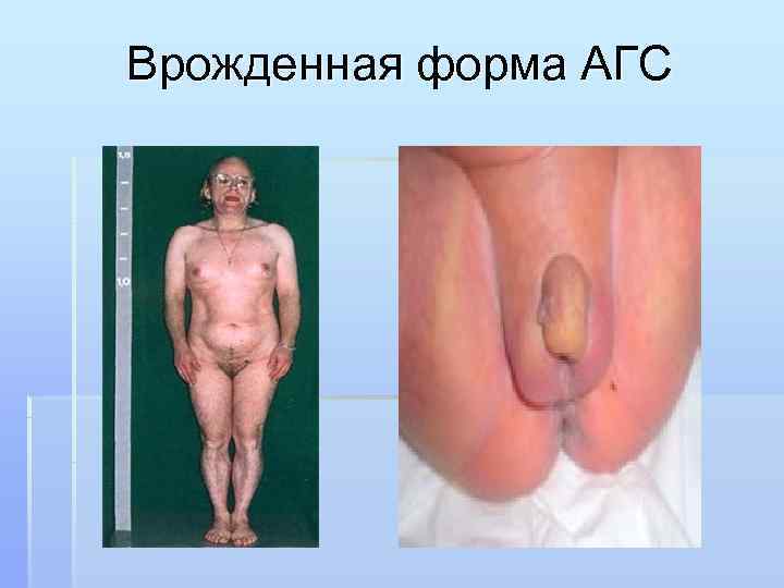 Врожденная форма АГС 