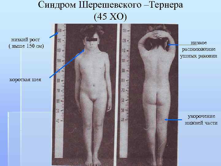   Синдром Шерешевского –Тернера     (45 ХО)  низкий рост