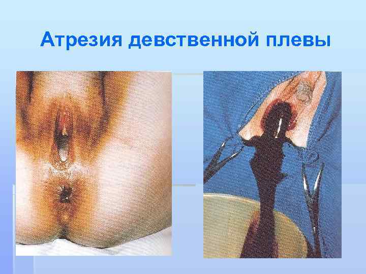 Атрезия девственной плевы 