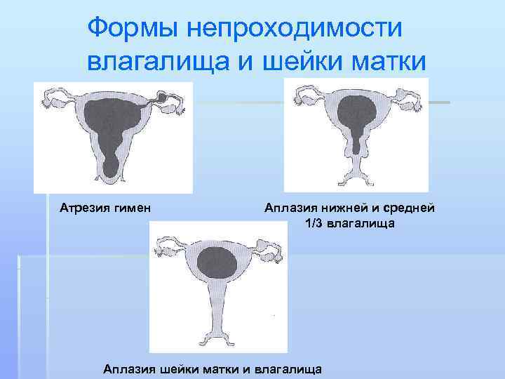   Формы непроходимости  влагалища и шейки матки Атрезия гимен   