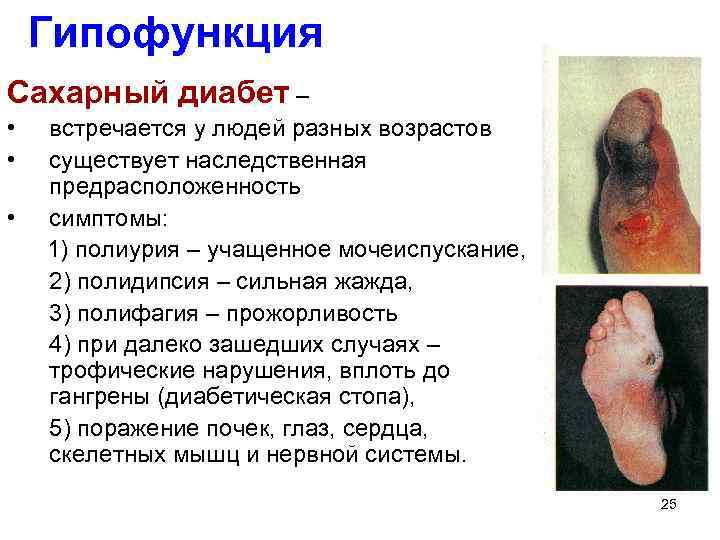 Гипофункция Сахарный диабет – • • • встречается у людей разных возрастов существует наследственная