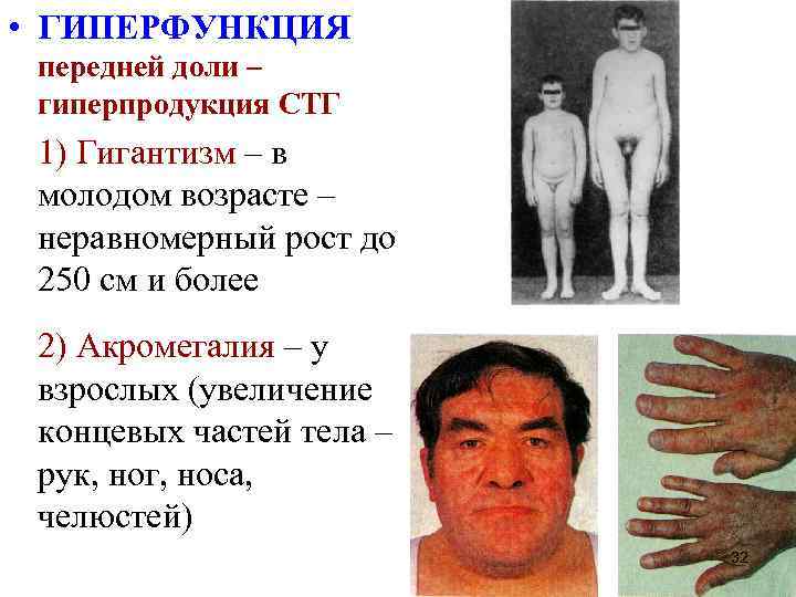  • ГИПЕРФУНКЦИЯ передней доли – гиперпродукция СТГ 1) Гигантизм – в молодом возрасте