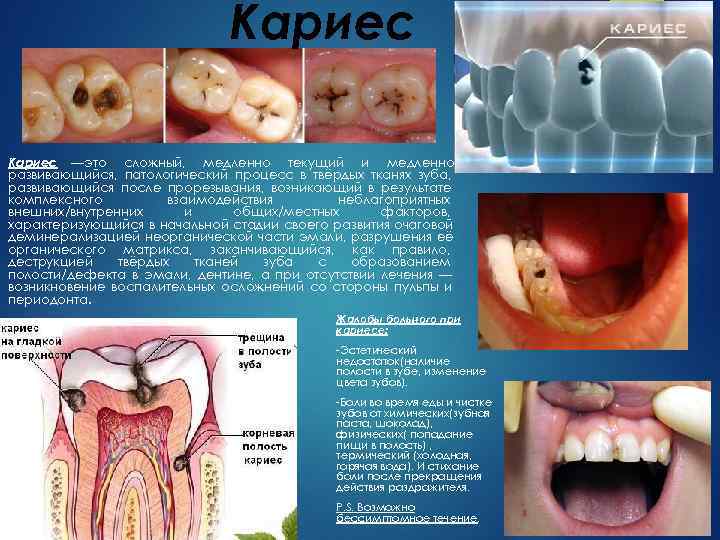      Кариес —это сложный, медленно текущий и медленно развивающийся, патологический