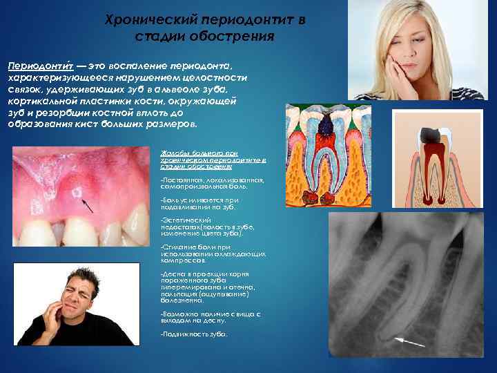     Хронический периодонтит в    стадии обострения Периодонти т