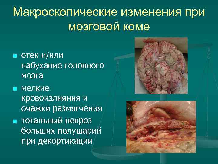 Макроскопические изменения при мозговой коме n отек и/или набухание головного мозга Макроскопические изменения при мозговой коме n отек и/или набухание головного мозга