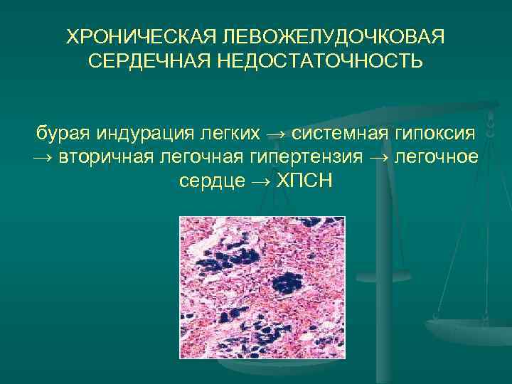 Легкая сердечная недостаточность. Патанатомия сердечной недостаточности. Патоморфология хронической сердечной недостаточности. Сердечная недостаточность патанатоми. Острая сердечная недостаточность ПАТ Анат.