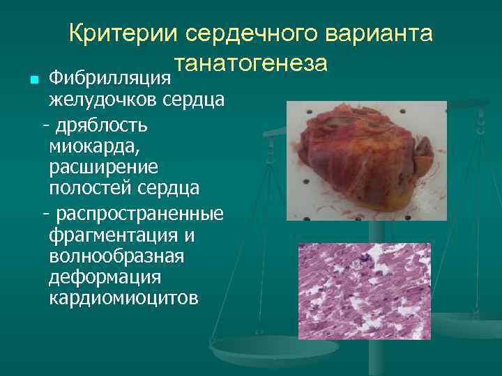 Критерии сердечного варианта танатогенеза n Фибрилляция желудочков сердца - Критерии сердечного варианта танатогенеза n Фибрилляция желудочков сердца -