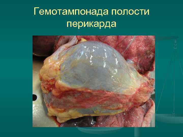 Гемотампонада полости перикарда Гемотампонада полости перикарда
