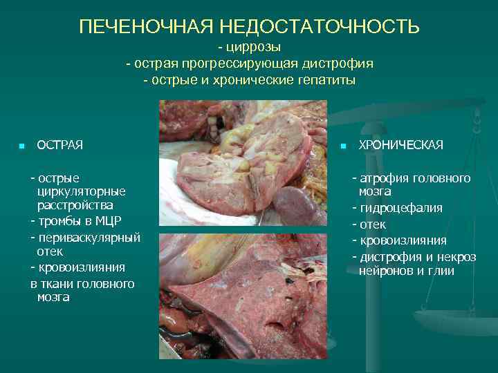 ПЕЧЕНОЧНАЯ НЕДОСТАТОЧНОСТЬ - циррозы ПЕЧЕНОЧНАЯ НЕДОСТАТОЧНОСТЬ - циррозы