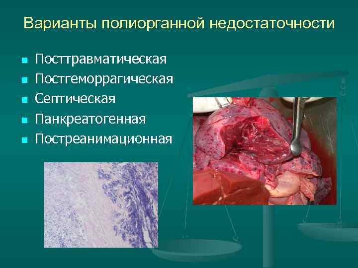 Варианты полиорганной недостаточности n Посттравматическая n Постгеморрагическая n Септическая n Варианты полиорганной недостаточности n Посттравматическая n Постгеморрагическая n Септическая n