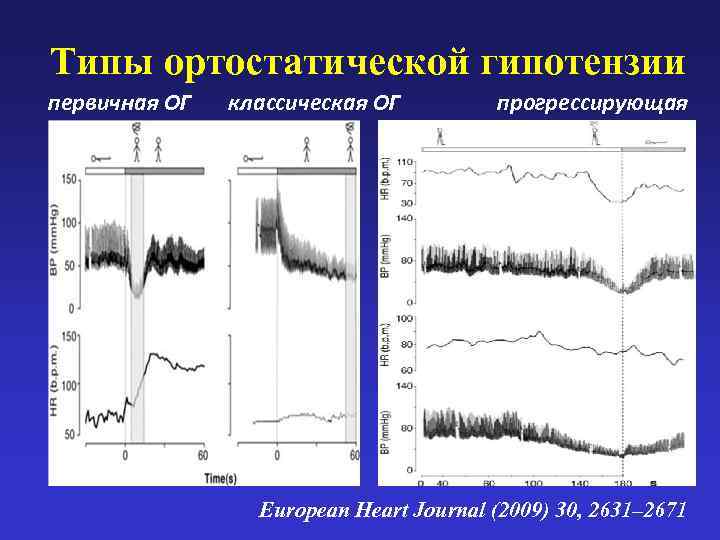 Типы ортостатической гипотензии первичная ОГ  классическая ОГ   прогрессирующая ОГ  