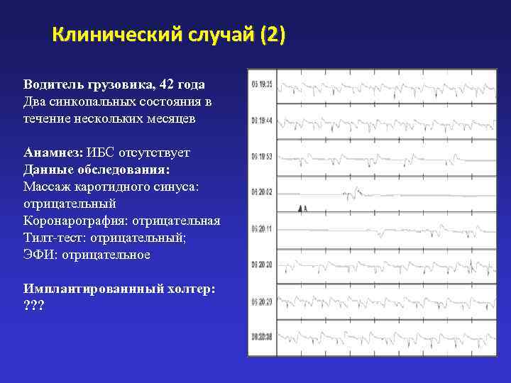   Клинический случай (2) Водитель грузовика, 42 года Два синкопальных состояния в течение