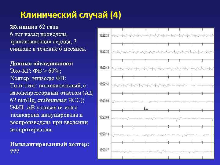   Клинический случай (4) Женщина 62 года 6 лет назад проведена трансплантация сердца,
