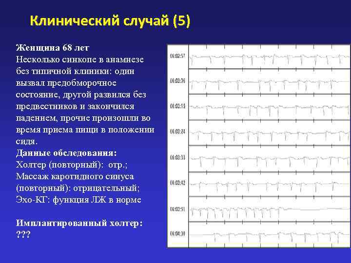   Клинический случай (5) Женщина 68 лет Несколько синкопе в анамнезе без типичной