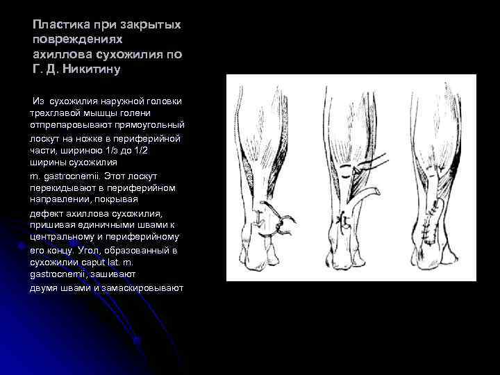 Пластика при закрытых повреждениях ахиллова сухожилия по Г. Д. Никитину  Из сухожилия наружной