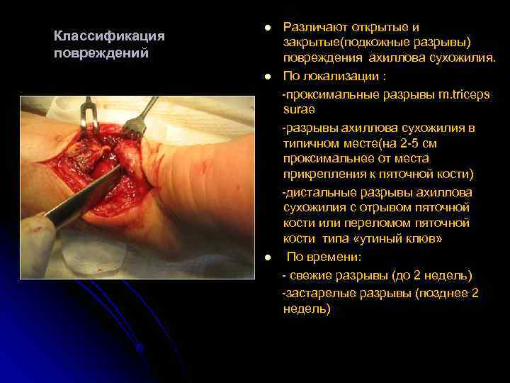     l  Различают открытые и Классификация  закрытые(подкожные разрывы) повреждений