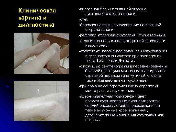    -внезапная боль на тыльной стороне Клиническая  дистального отдела голени картина