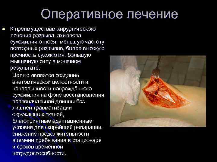    Оперативное лечение l  К преимуществам хирургического лечения разрыва ахиллова сухожилия