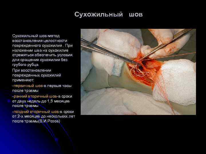       Сухожильный шов-метод восстановления целостности поврежденного сухожилия. При наложении