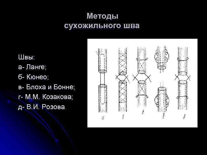   Методы   сухожильного шва  Швы: а- Ланге; б- Кюнео;