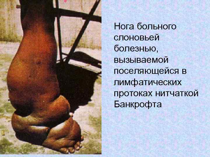 Нога больного слоновьей болезнью, вызываемой поселяющейся в лимфатических протоках нитчаткой Банкрофта 