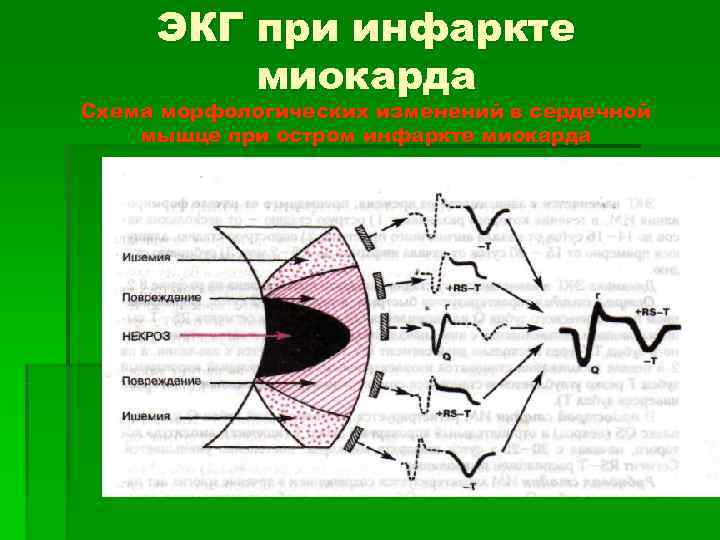  ЭКГ при инфаркте   миокарда Схема морфологических изменений в сердечной мышце при