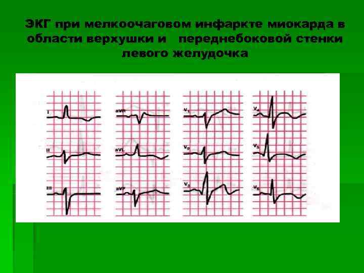 ЭКГ при мелкоочаговом инфаркте миокарда в области верхушки и переднебоковой стенки   левого