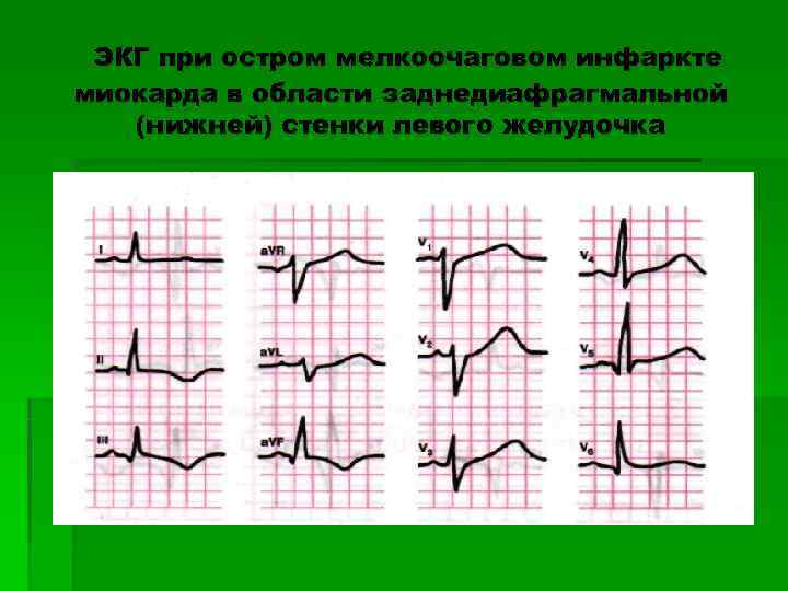  ЭКГ при остром мелкоочаговом инфаркте миокарда в области заднедиафрагмальной  (нижней) стенки левого