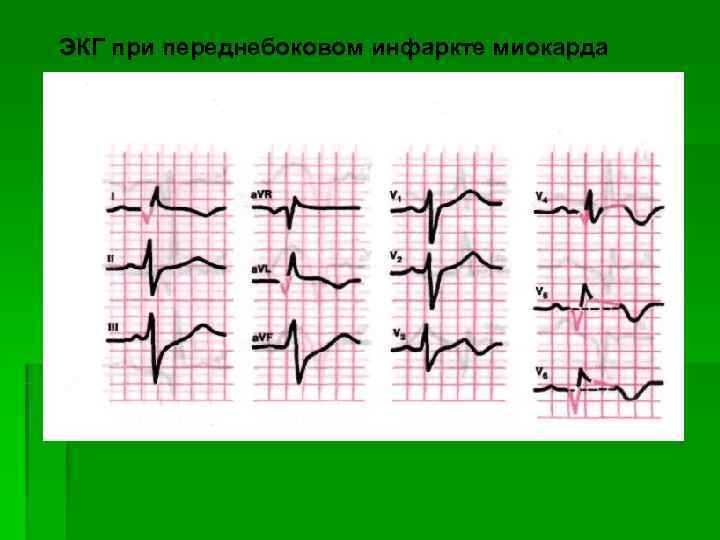 ЭКГ при переднебоковом инфаркте миокарда 