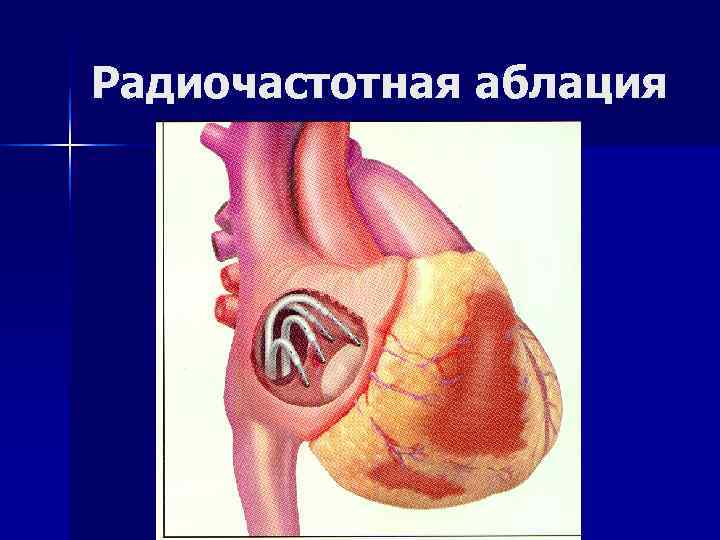 Радиочастотная аблация Радиочастотная аблация