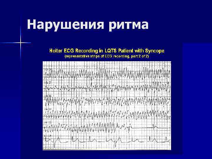 Нарушения ритма Нарушения ритма