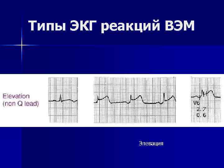 Типы ЭКГ реакций ВЭМ Элевация Типы ЭКГ реакций ВЭМ Элевация