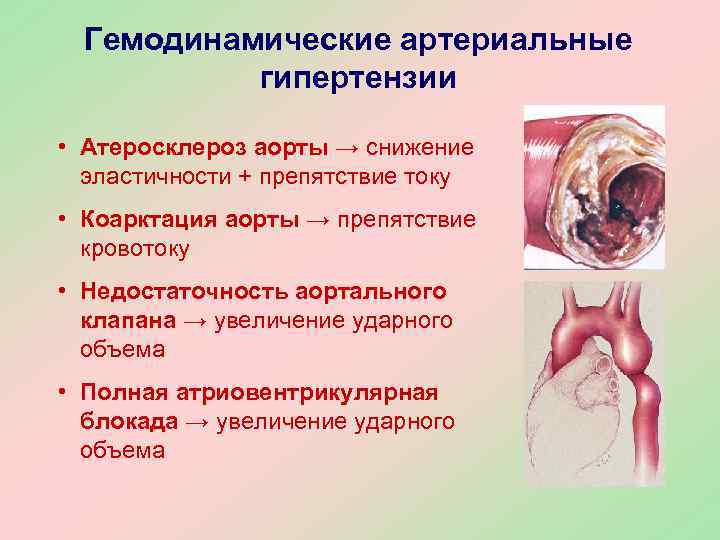  Гемодинамические артериальные  гипертензии  • Атеросклероз аорты → снижение  эластичности +