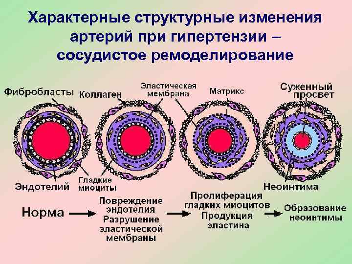 Характерные структурные изменения артерий при гипертензии –  сосудистое ремоделирование 