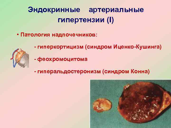   Эндокринные артериальные   гипертензии (I) • Патология надпочечников:  - гиперкортицизм