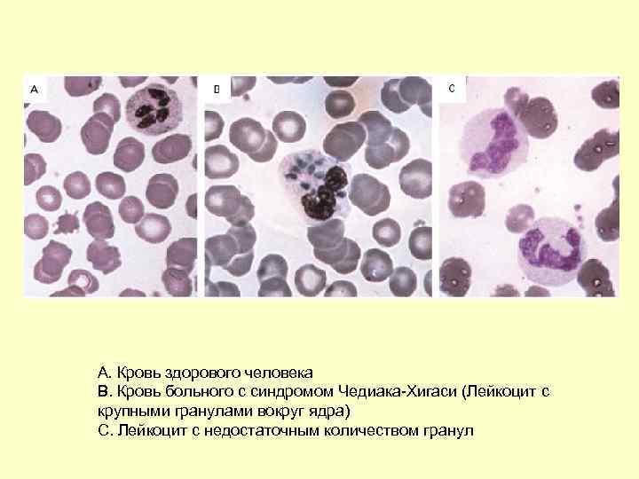   A. Кровь здорового человека   B. Кровь больного с синдромом Чедиака-Хигаси