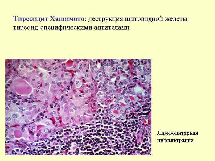 Тиреоидит Хашимото: деструкция щитовидной железы тиреоид-специфическими антителами    Лимфоцитарная   
