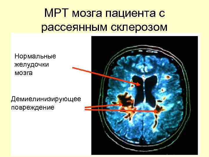   МРТ мозга пациента с   рассеянным склерозом Нормальные желудочки мозга 