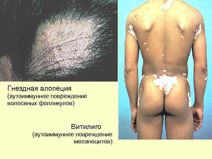 Гнездная алопеция (аутоиммунное повреждение волосяных фолликулов)      Витилиго  (аутоиммунное