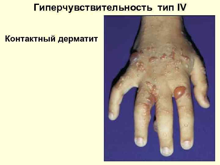  Гиперчувствительность тип IV  Контактный дерматит 
