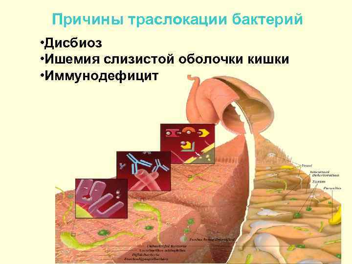  Причины траслокации бактерий • Дисбиоз • Ишемия слизистой оболочки кишки • Иммунодефицит 