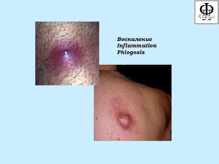 Воспаление Inflammation Phlogosis 