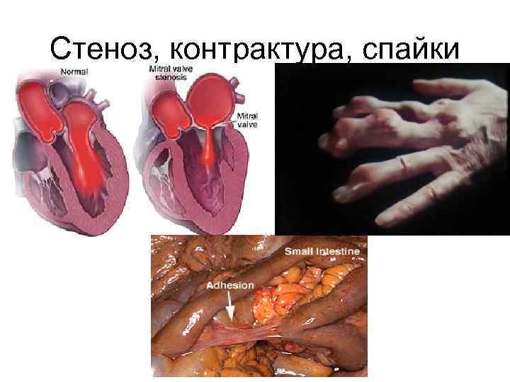 Стеноз, контрактура, спайки 
