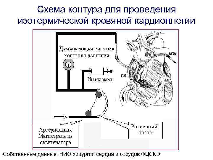 Схема системы экстракорпорального кровообращения