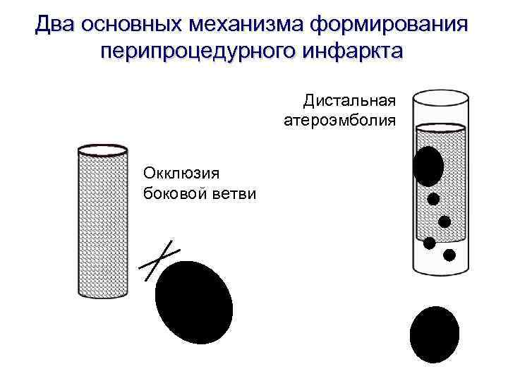 Два основных механизма формирования перипроцедурного инфаркта Дистальная Два основных механизма формирования перипроцедурного инфаркта Дистальная