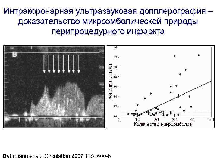 Интракоронарная ультразвуковая допплерография – доказательство микроэмболической природы перипроцедурного инфаркта Bahrmann et al. Интракоронарная ультразвуковая допплерография – доказательство микроэмболической природы перипроцедурного инфаркта Bahrmann et al.