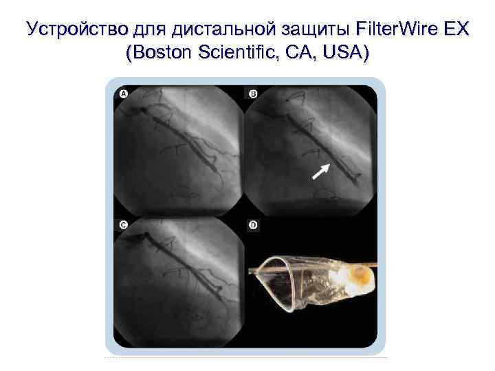 Устройство для дистальной защиты Filter. Wire EX (Boston Scientific, CA, USA) Устройство для дистальной защиты Filter. Wire EX (Boston Scientific, CA, USA)
