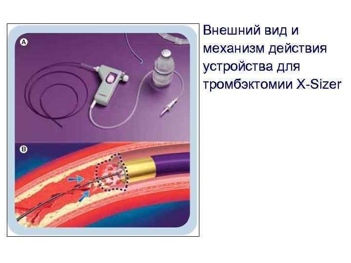 Внешний вид и механизм действия устройства для тромбэктомии X-Sizer Внешний вид и механизм действия устройства для тромбэктомии X-Sizer
