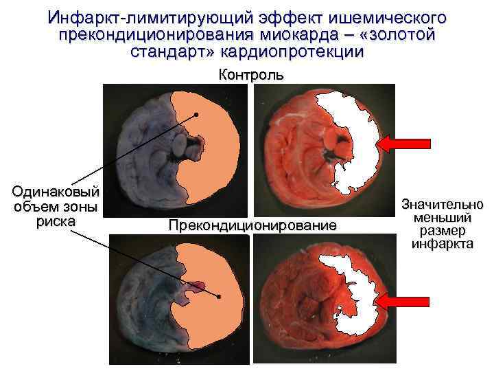 Инфаркт-лимитирующий эффект ишемического прекондиционирования миокарда – «золотой стандарт» кардиопротекции Инфаркт-лимитирующий эффект ишемического прекондиционирования миокарда – «золотой стандарт» кардиопротекции