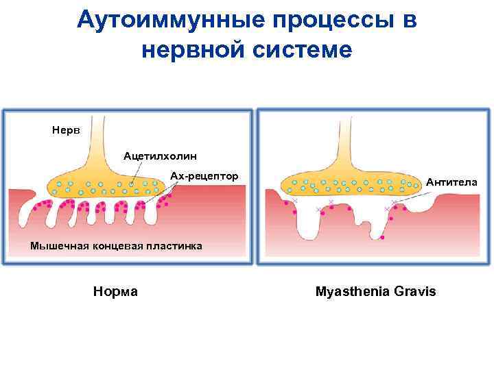 Аутоиммунные процессы в нервной системе Нерв Ацетилхолин Аутоиммунные процессы в нервной системе Нерв Ацетилхолин